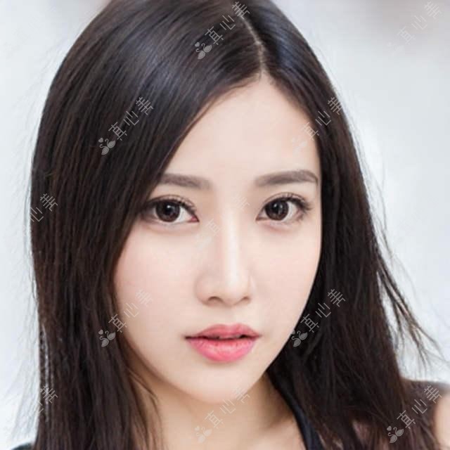 镇江嘟嘟唇项目体验分享:塑形+饱满疗效自然,价格2k左右,但维持时间6-8个月