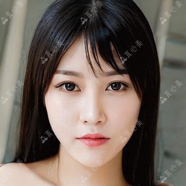 安阳异体皮填充卧蚕会吸收吗 卧蚕填充疗效持久性及价格解析