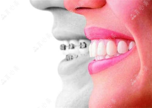 深圳马泷齿科VS穗华口腔:种植牙&隐形矫正哪家强?实地探访这两家网红牙科