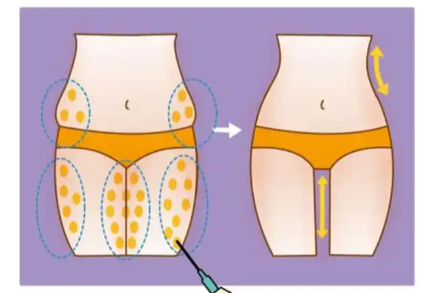 十二、吸脂塑形手术:9800元起,适合希望减脂塑形的人群