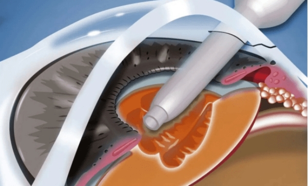 为什么医生不建议做晶体植入？这些晶体植入禁忌症你知道几个