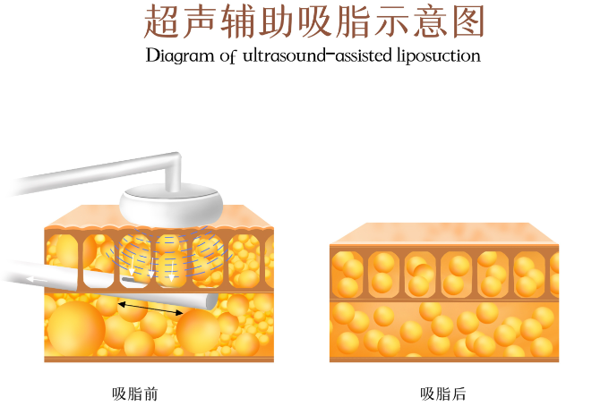 抽脂手术需要多少钱？面部吸脂大概1万到2万，全身抽脂可能要2万以上