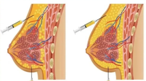 北京隆胸多少钱？国产假体1.5到3.5万，进口假体2.5到15万，自体脂肪1万起