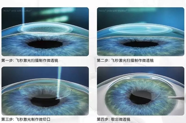 全飞秒坚持不了30秒怎么办？通过术前训练都能完成飞秒手术