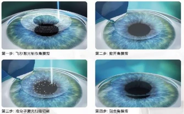 半飞秒三大禁忌你中招了吗？严禁揉眼，避免剧烈运动，做好防水防污