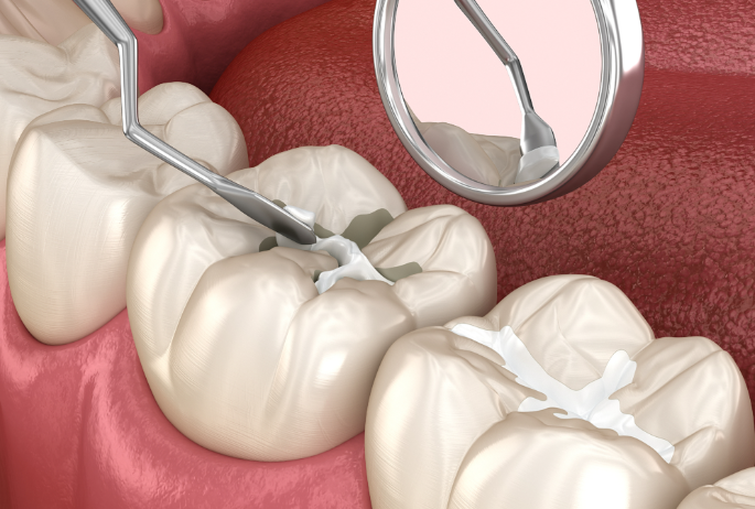 六、树脂补牙缝容易掉吗？价格判断参考