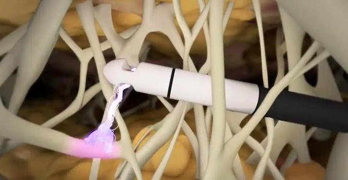 一、吸脂腰腹部1到30天图片解析：术后全过程详解