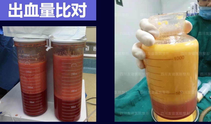 吸脂肪手术多少钱？2026年不同部位价格对比及注意事项