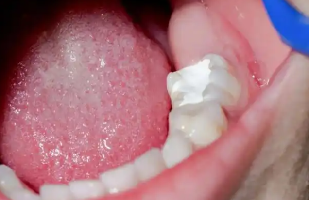 八、树脂补牙分几种材料的价格总结