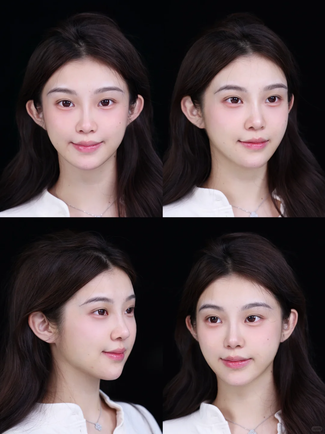 二、深圳美莱整形医院林登文医生的技术优势