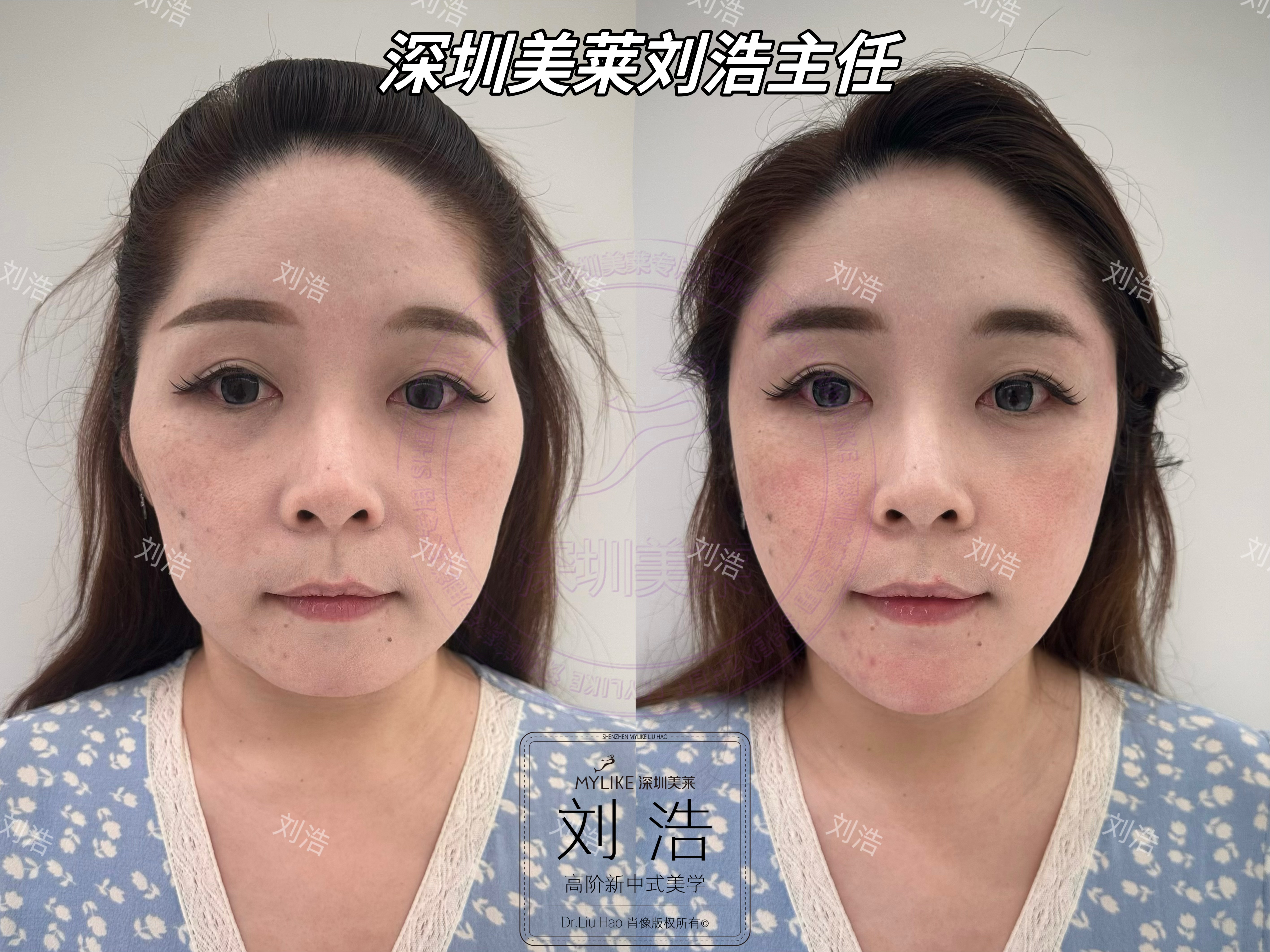 四、深圳美莱整形医院林登文医生的预约与服务流程