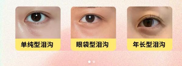 四、泪沟填充的替代材料推荐