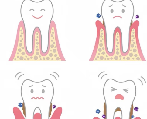 三、如何预防和应对牙龈萎缩对邻牙的影响