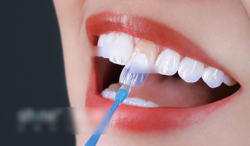 石家庄牙齿瓷贴面多少钱一颗？国产的便宜2500到4500元