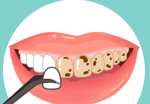 二、石家庄牙齿瓷贴面多少钱一颗？选购时需注意的几个问题