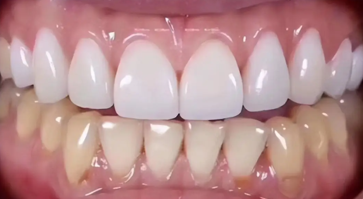 三、石家庄牙齿瓷贴面多少钱一颗？如何根据预算做出合理选择