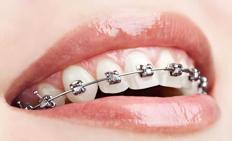 三、普特自锁托槽的核心优势