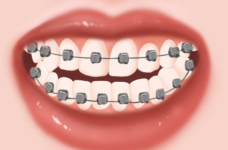 普特最新7代自锁托槽和亚新哪个更值得入手