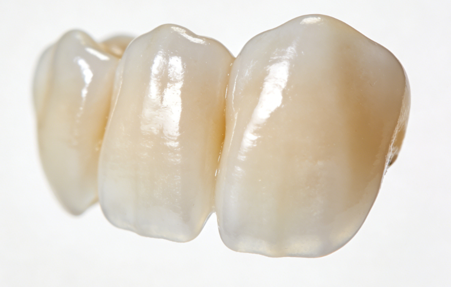 二、门牙修复材料选择指南：如何根据需求挑选牙冠