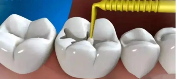 银汞补牙全过程全解析：步骤、材料、安全性及价格疑问一网打尽！