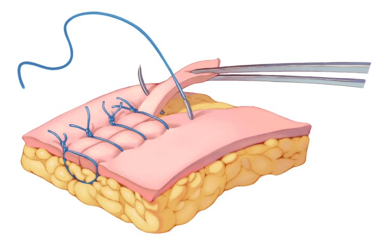 二、肋骨隆鼻建议做吗｜优缺点全方面对比