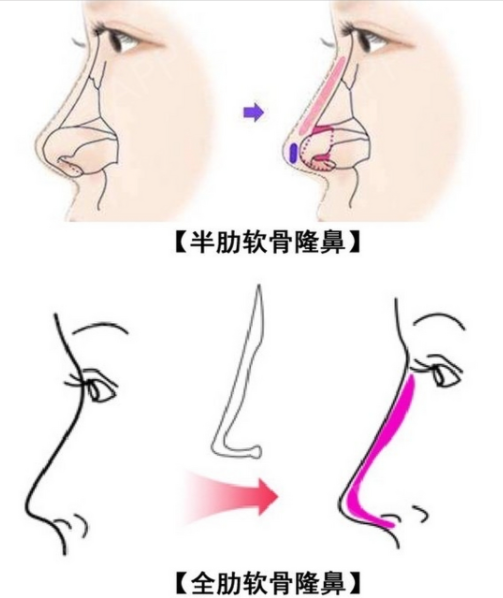 肋骨隆鼻好处与坏处有哪些？材料安全，不容易被排斥，创伤大