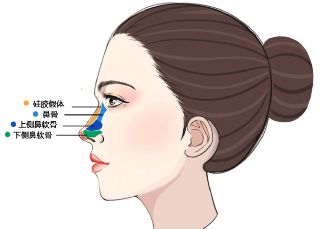 三、适合接受肋骨隆鼻的人群与注意事项