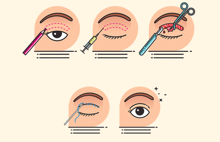 二、影响开眼角拆线疼痛感的关键因素