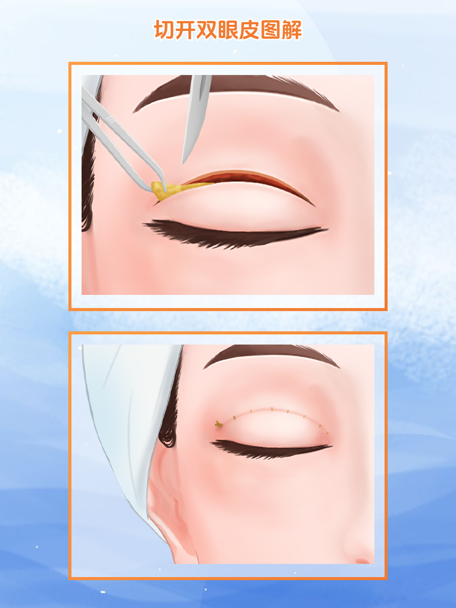 二、三点定位双眼皮能维持几年？术后护理对疗效的影响