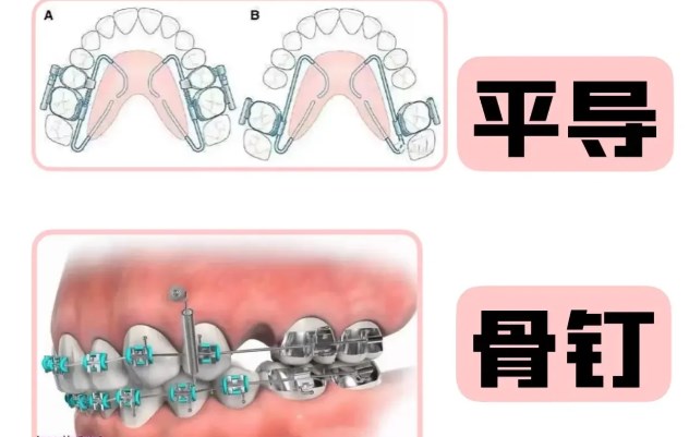 三、牙齿矫正多少钱一套：避坑指南