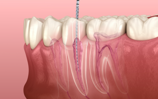 三、影响根管治疗费用的关键因素