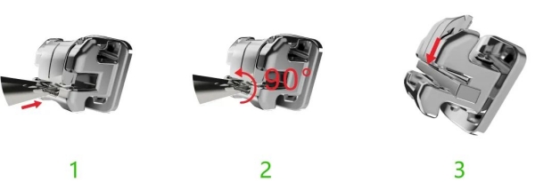 三、金属牙套 vs. 陶瓷牙套：如何选择更合适的修复方案