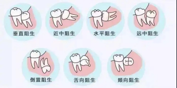 河北邯郸李志杰口腔拔智齿多少钱一颗？完全埋伏智齿拔除1000–2000