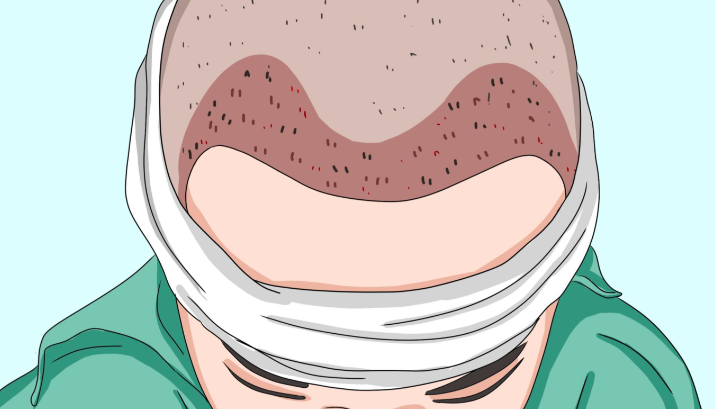 2026柳州植发医院排名出炉！贞韩、天美、华美、新生天美技术价格全解析