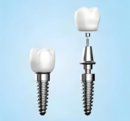 江门种牙价格哪家更划算？种植体价格排序瑞士 > 德国 > 韩国 > 国产
