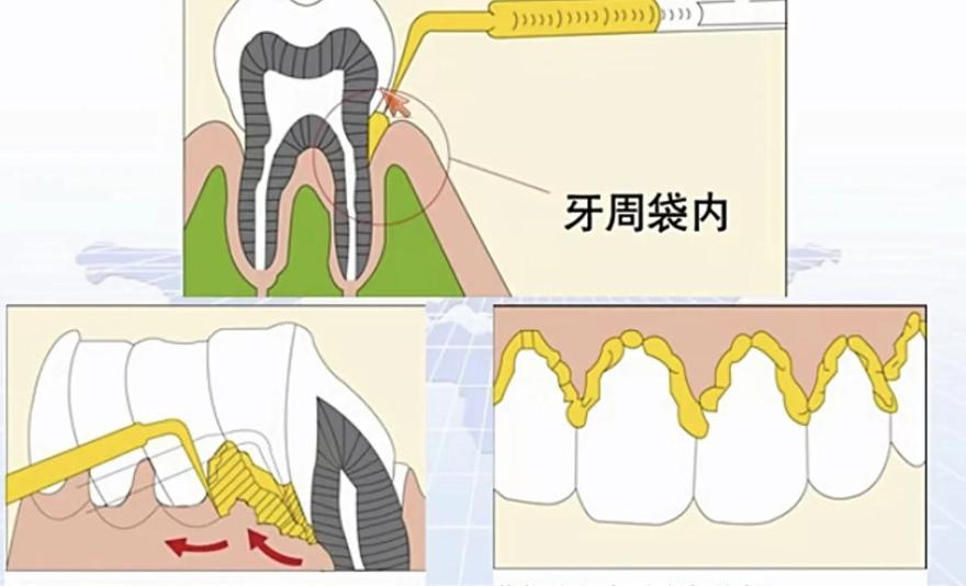 四、牙周治疗类项目的价格范围
