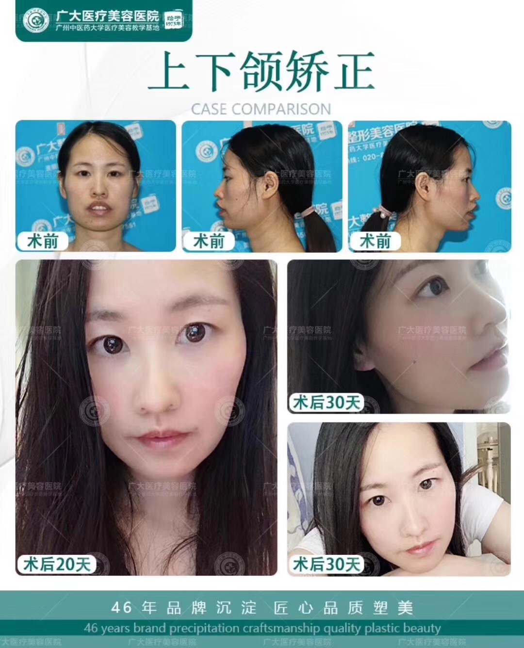 三、广州广大口腔医院凸嘴手术的适用人群与手术疗效