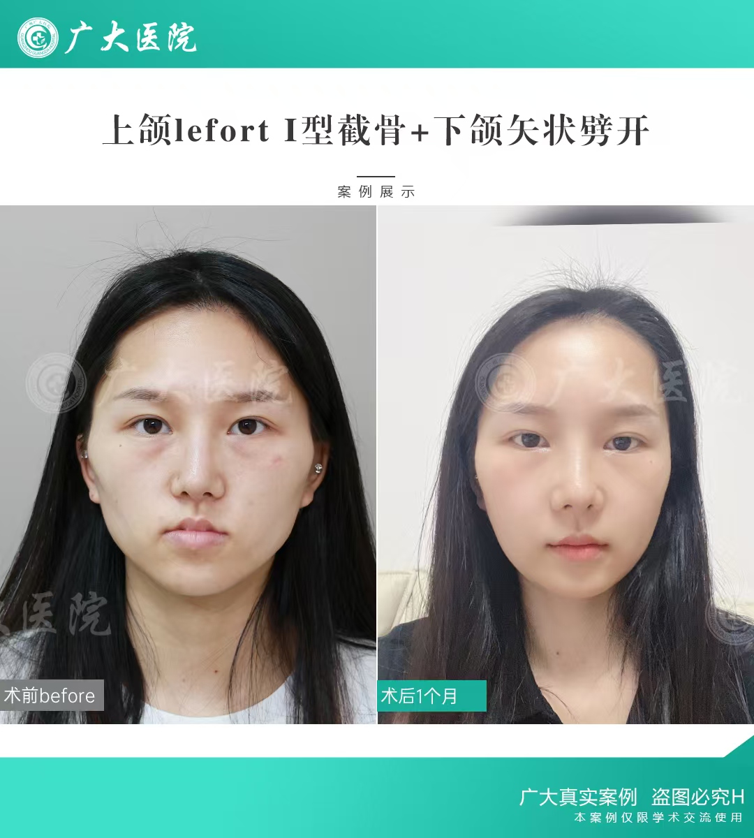 四、广州广大口腔医院凸嘴手术的术后与护理建议