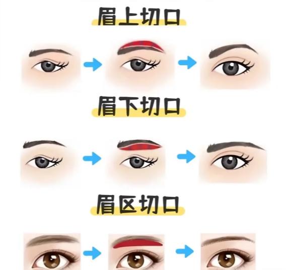 提眉术后1-7天照片真实案例：从肿胀到自然恢复全过程