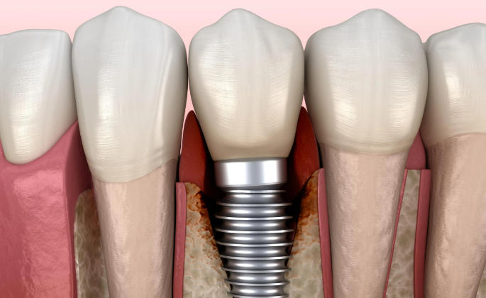 三、诺贝尔种植体CC与PMC型号的对比