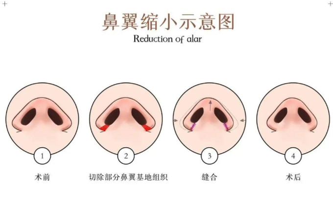 二、2026年缩鼻翼手术价格参考及地区差异