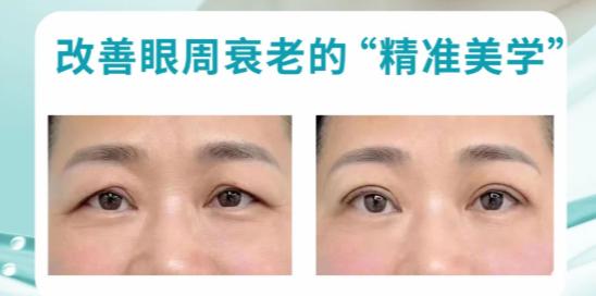 三、内窥镜提眉术的潜在风险与应对措施