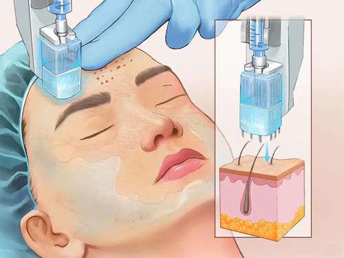 六、选择超声炮的建议