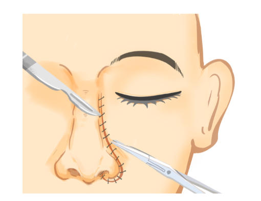 二、影响肋骨隆鼻长期疗效的关键因素