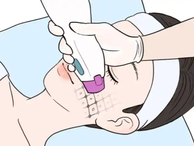 二、半岛超声炮全脸治疗价格