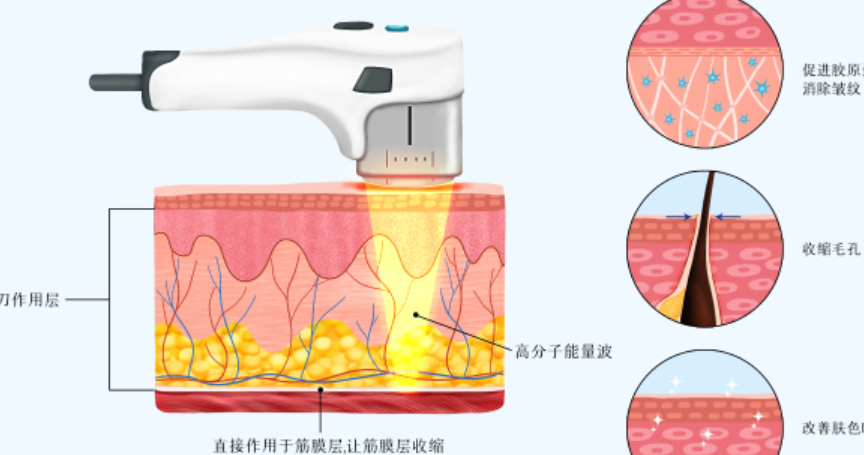 七、影响半岛超声炮价格的关键因素