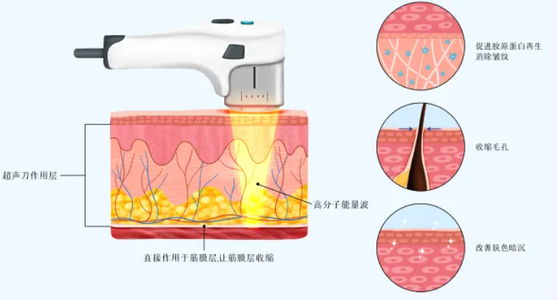 八、半岛超声炮性价比公式