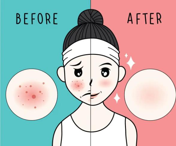 二、AOPT超光子的治疗模式与滤光片组合