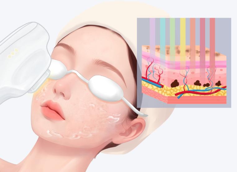 aopt超光子的功效与作用到底多有效？光波刺激胶原再生，让皮肤更紧致、细腻