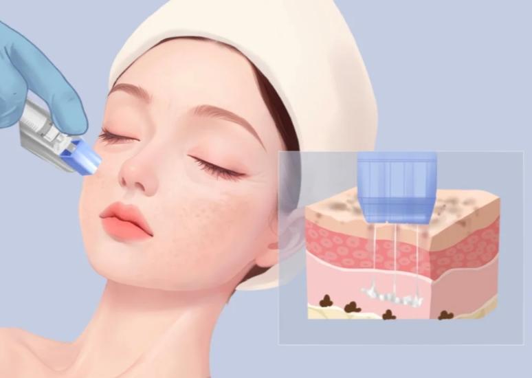 润致娃娃水光2ml多少钱？注射后护理注意事项